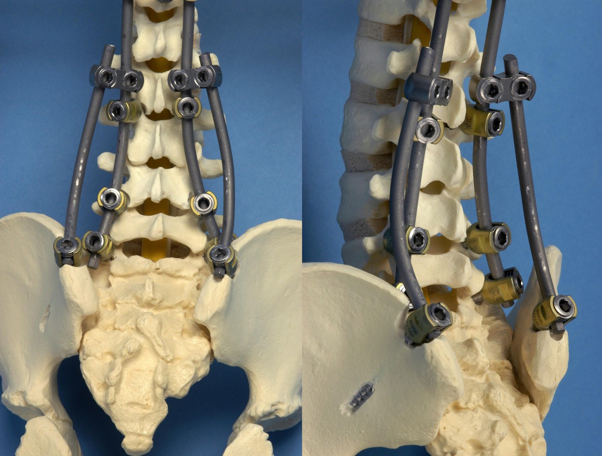The flying buttress construct for posterior spinopelvic fixation a