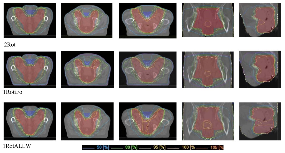 A Fast Radiotherapy Paradigm For Anal Cancer With Volumetric Modulated Arc Therapy Vmat