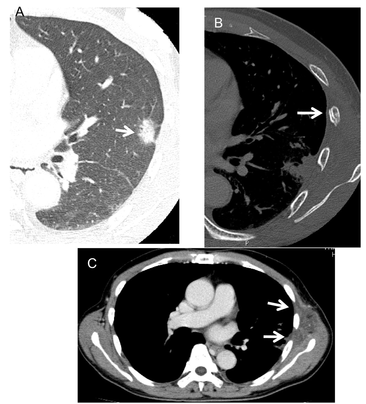 Rib fracture after stereotactic radiotherapy on follow-up ...