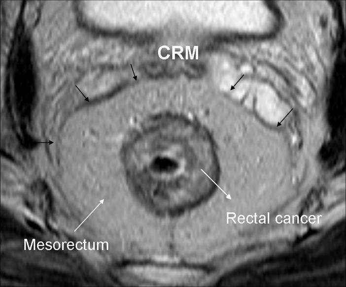 Preoperative rectal cancer staging with phased-array MR | Radiation