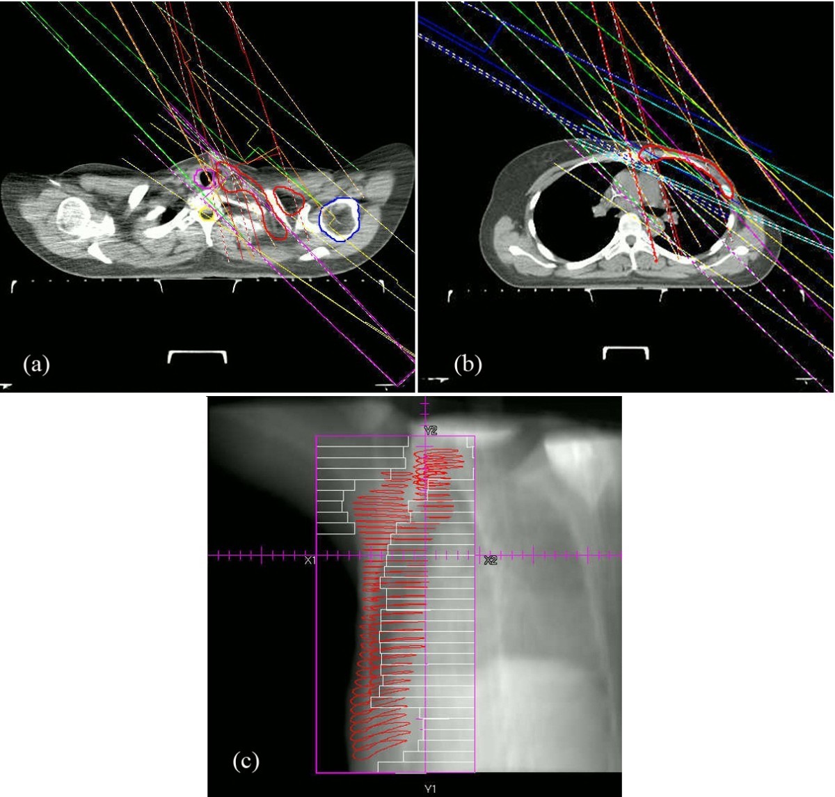 Post mastectomy linac IMRT irradiation of chest wall and regional nodes