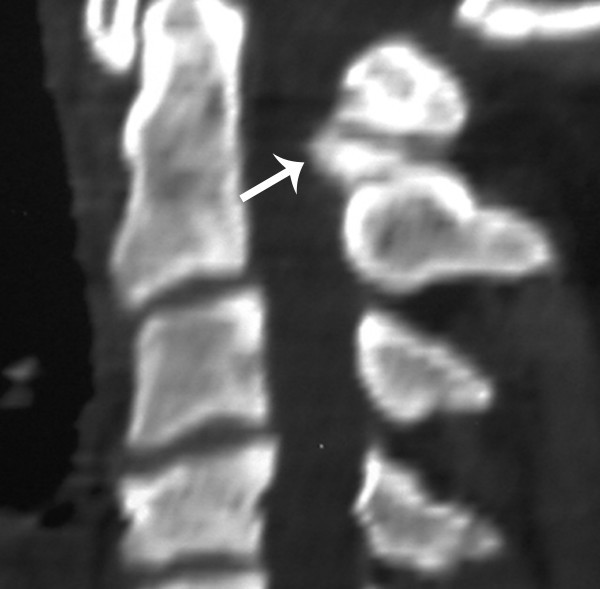 Recurrent burner syndrome due to presumed cervical spine osteoblastoma