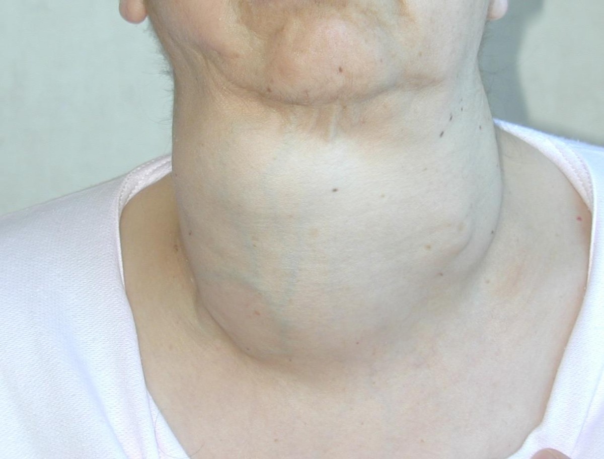 Emergency total thyroidectomy due to non traumatic disease. Experience