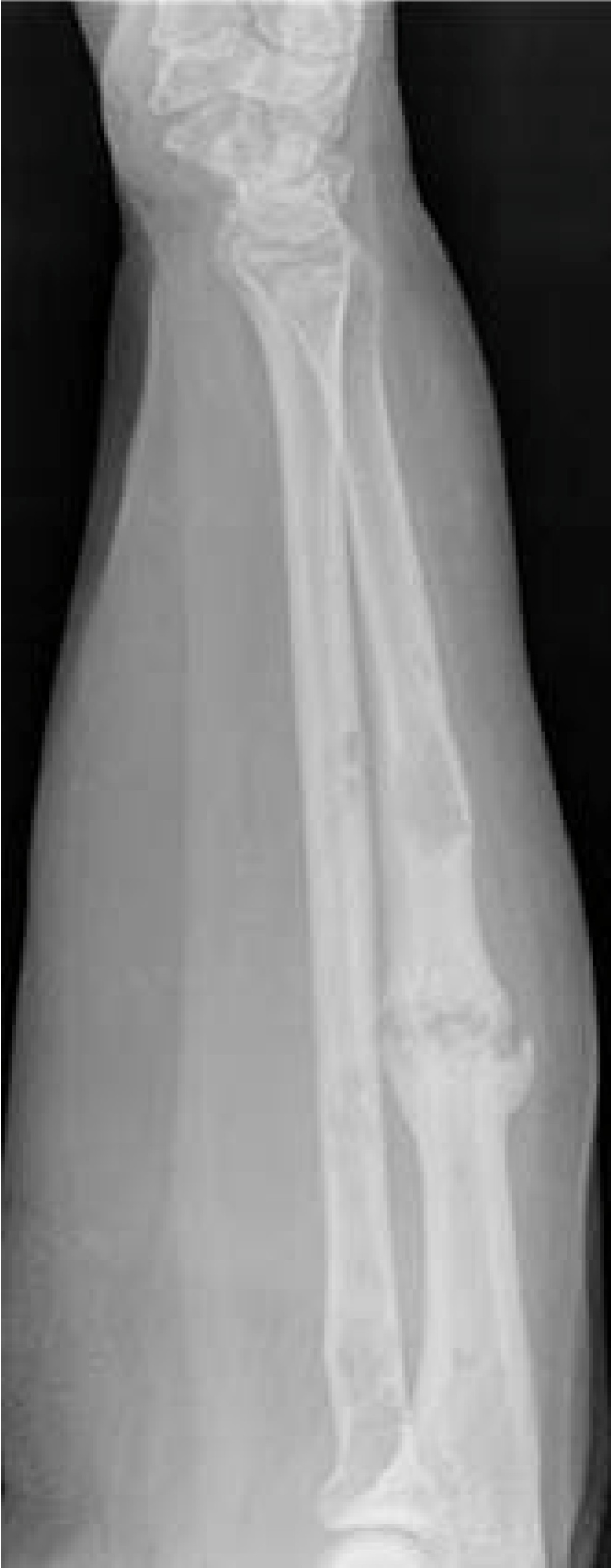 Hypertrophic non-union of a pathological forearm fracture ...