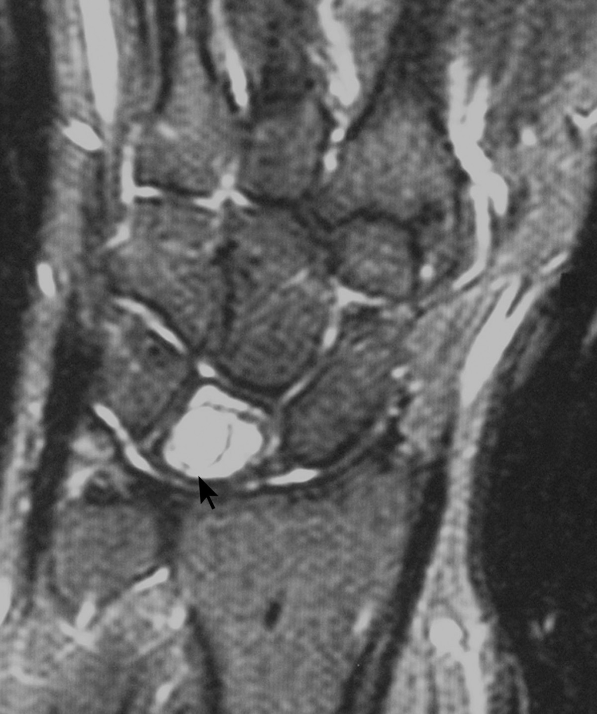 Unicameral bone cyst of the lunate in an adult case report Journal