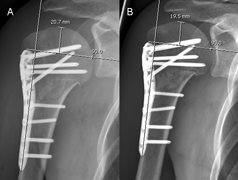 The calcar screw in angular stable plate fixation of proximal humeral fractures a case study