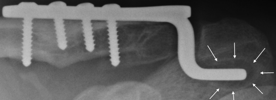 Hook plate fixation of acute displaced lateral clavicle
