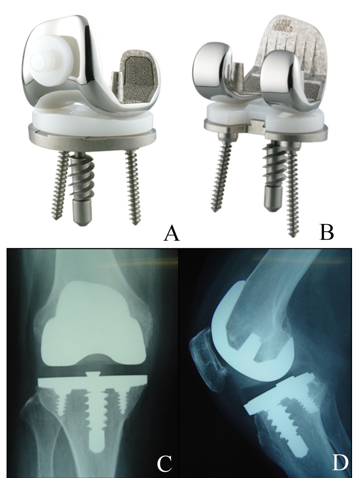 Clinical results of Hitech Knee II total knee arthroplasty in patients