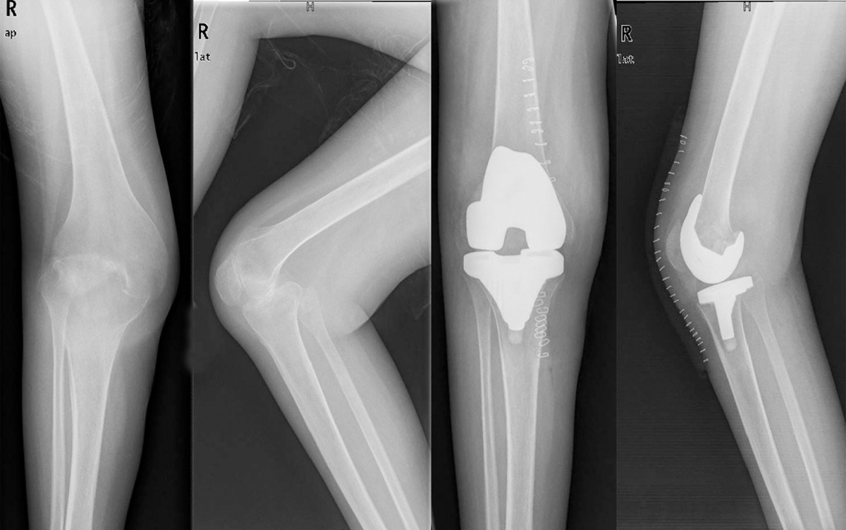 Total knee arthroplasty treatment of rheumatoid arthritis