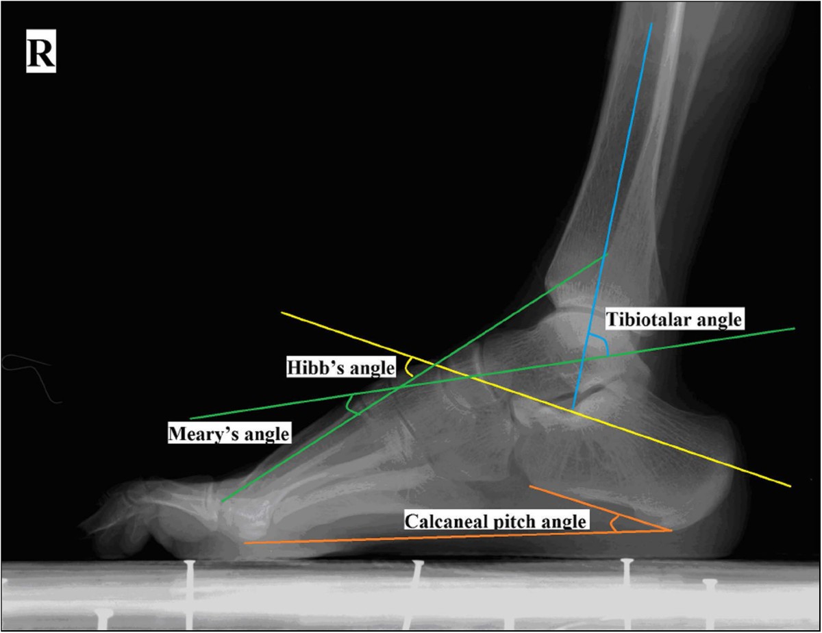 A prospective study of midfoot osteotomy combined with adjacent joint