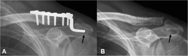 Clavicular hook plate may induce subacromial shoulder