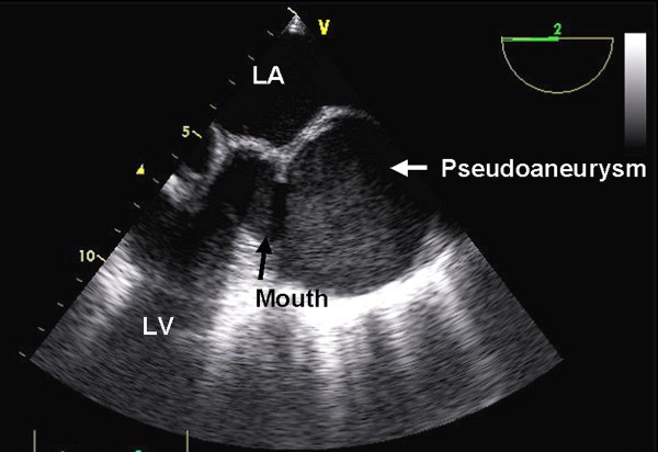 Subannular left ventricular pseudoaneurysm following mitral valve ...
