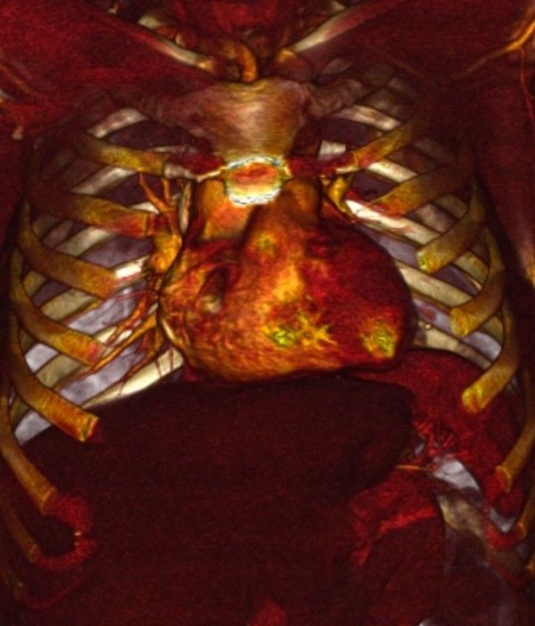 Long-term results of diaphragmatic plication in adults with unilateral