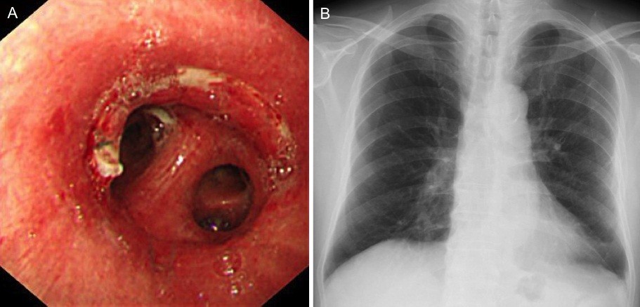 Bronchial sleeve resection for early-stage squamous cell carcinoma