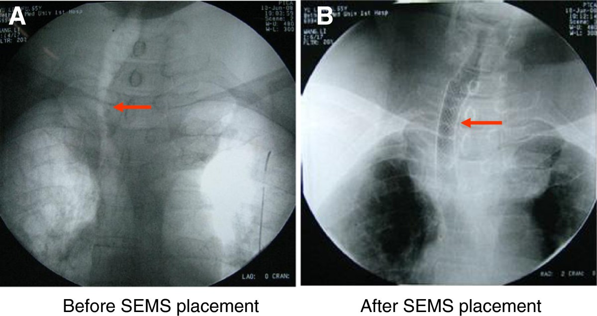 Successful management of trachea stenosis with massive substernal