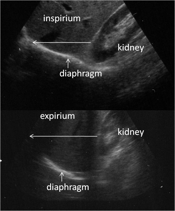 Diaphragm motion and lung function prediction in patients operated for