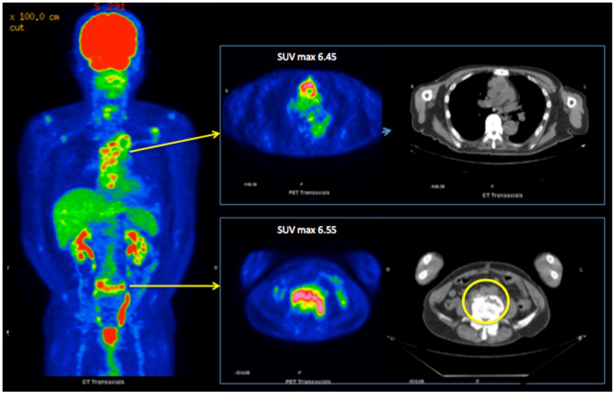 Usefulness of 18 FFDGPET/CT in aortic graft infection two cases