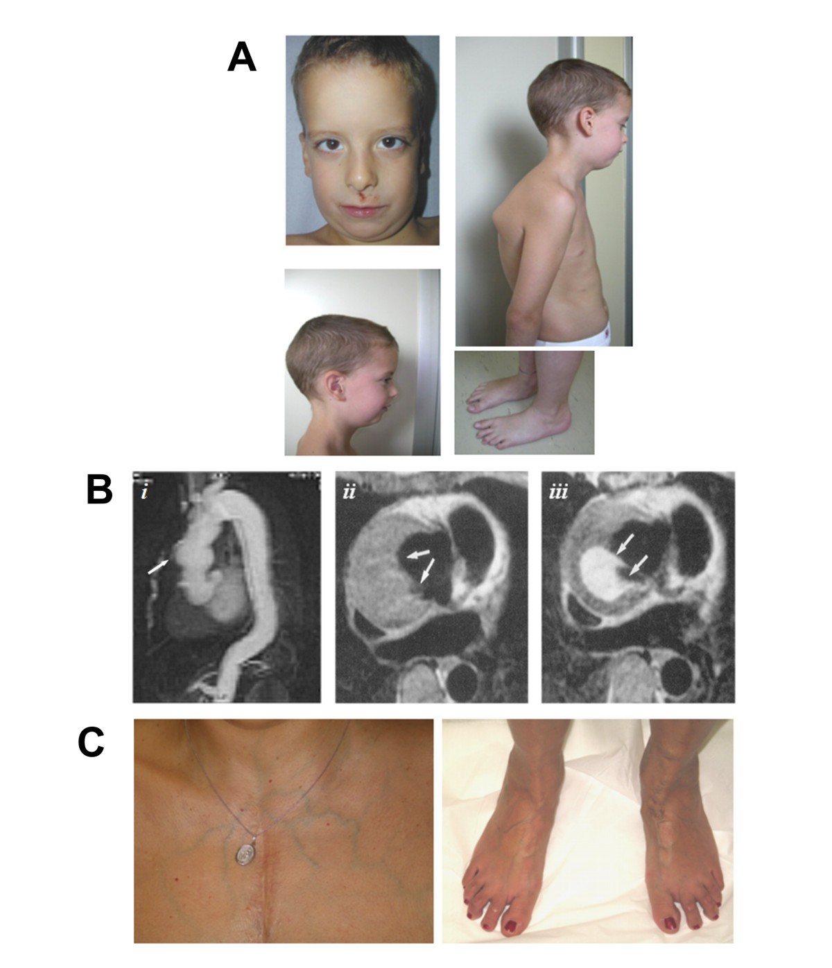 LoeysDietz syndrome type I and type II clinical findings