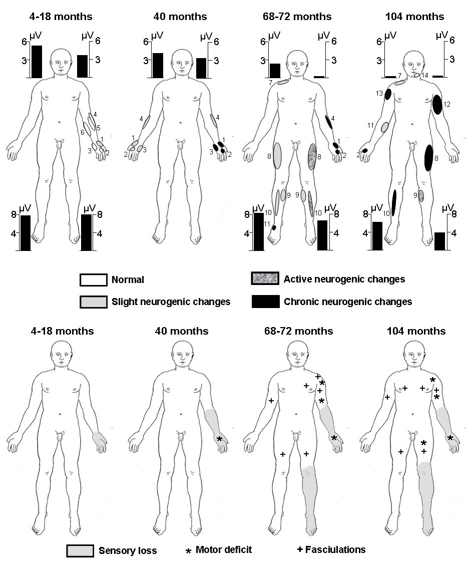 Sensory and motor neuronopathy in a patient with the A382P TDP43