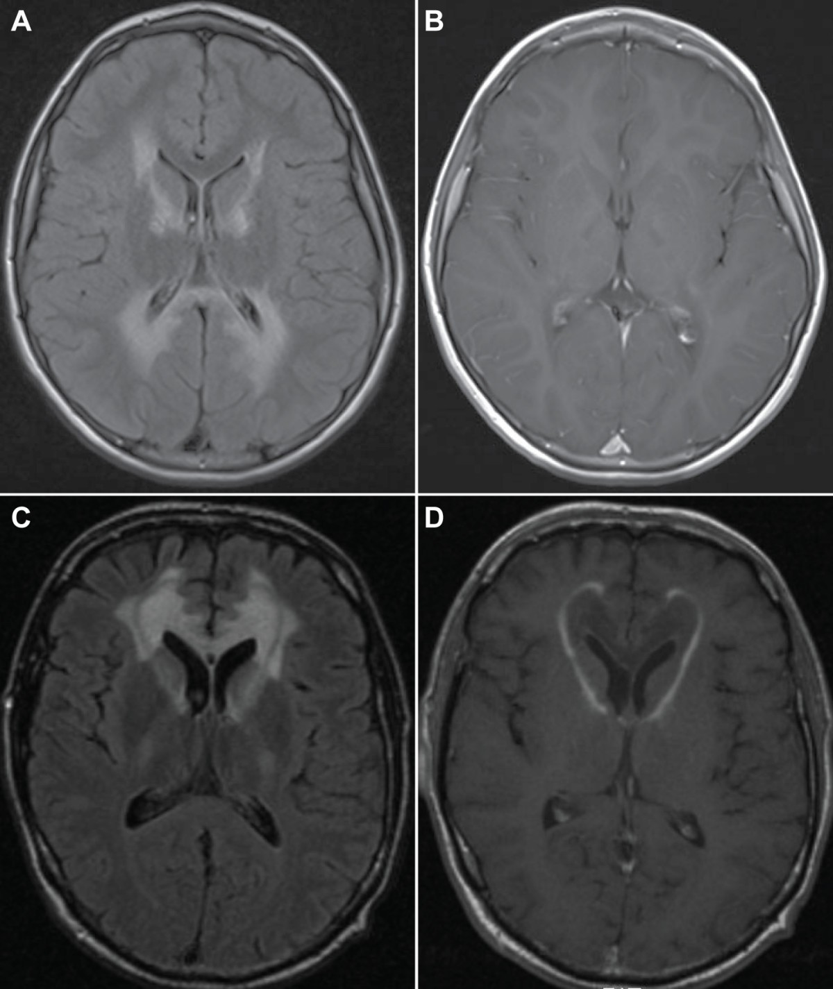 x linked adrenoleukodystrophy x linked adrenoleukodystrophy