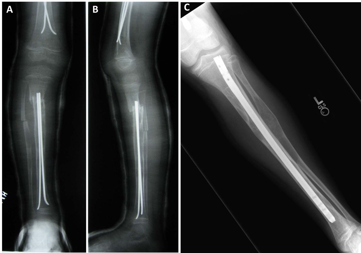 The surgical management of fibrous dysplasia of bone | Orphanet Journal