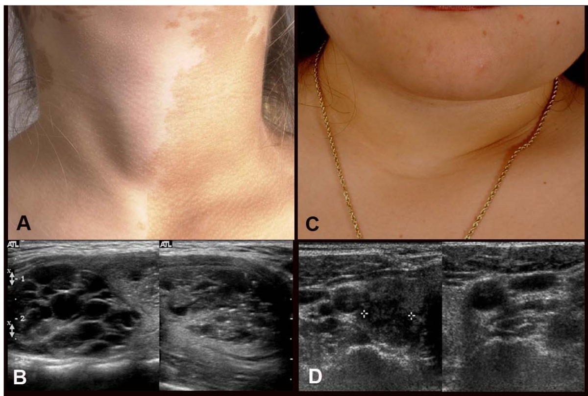 McCuneAlbright syndrome and the extraskeletal manifestations of