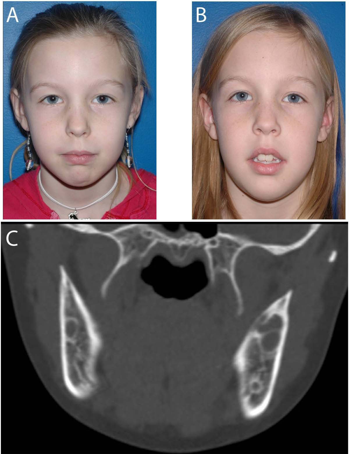 Cherubism: best clinical practice | Orphanet Journal of ...