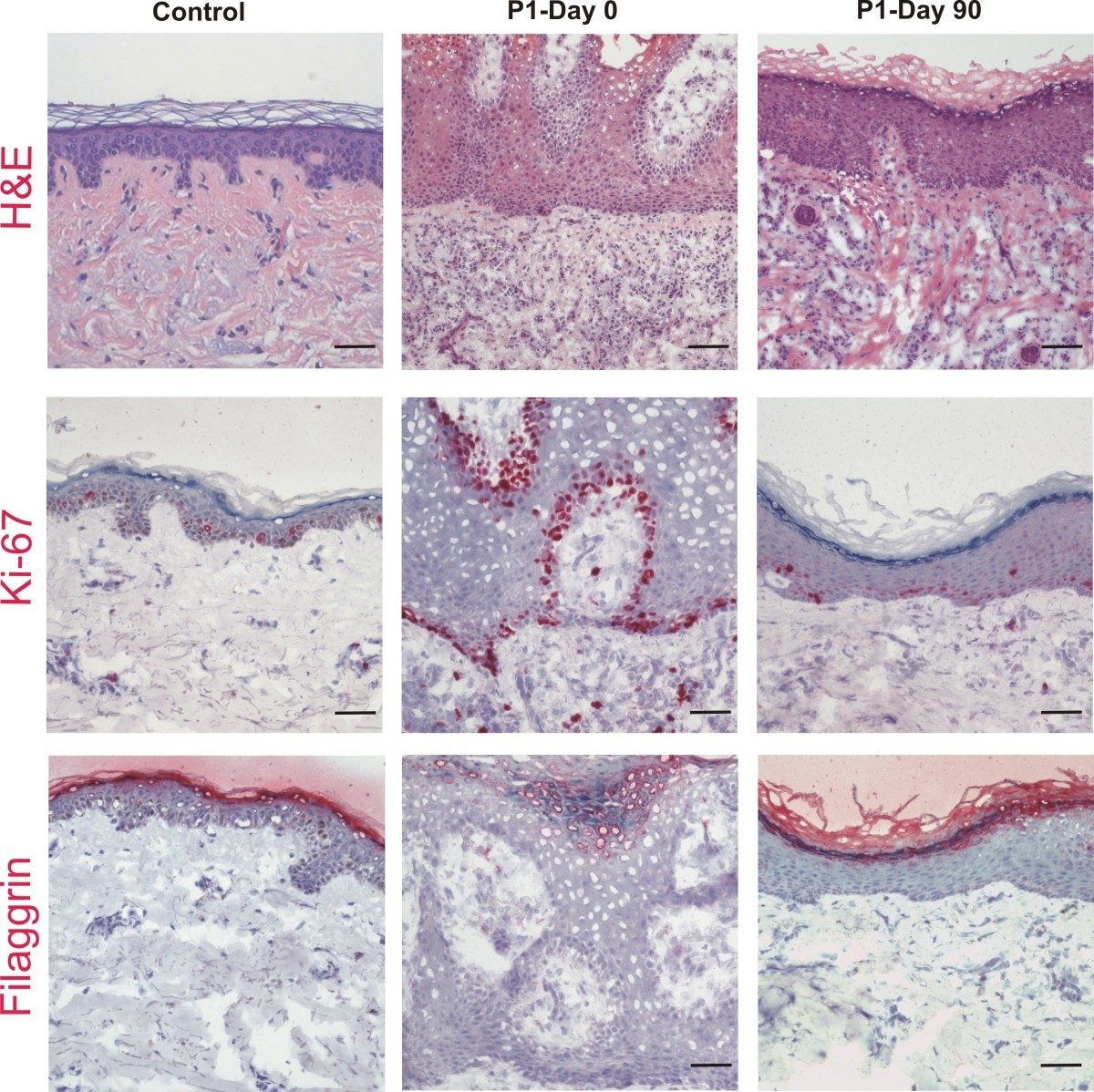 Targeting epidermal lipids for treatment of Mendelian disorders of