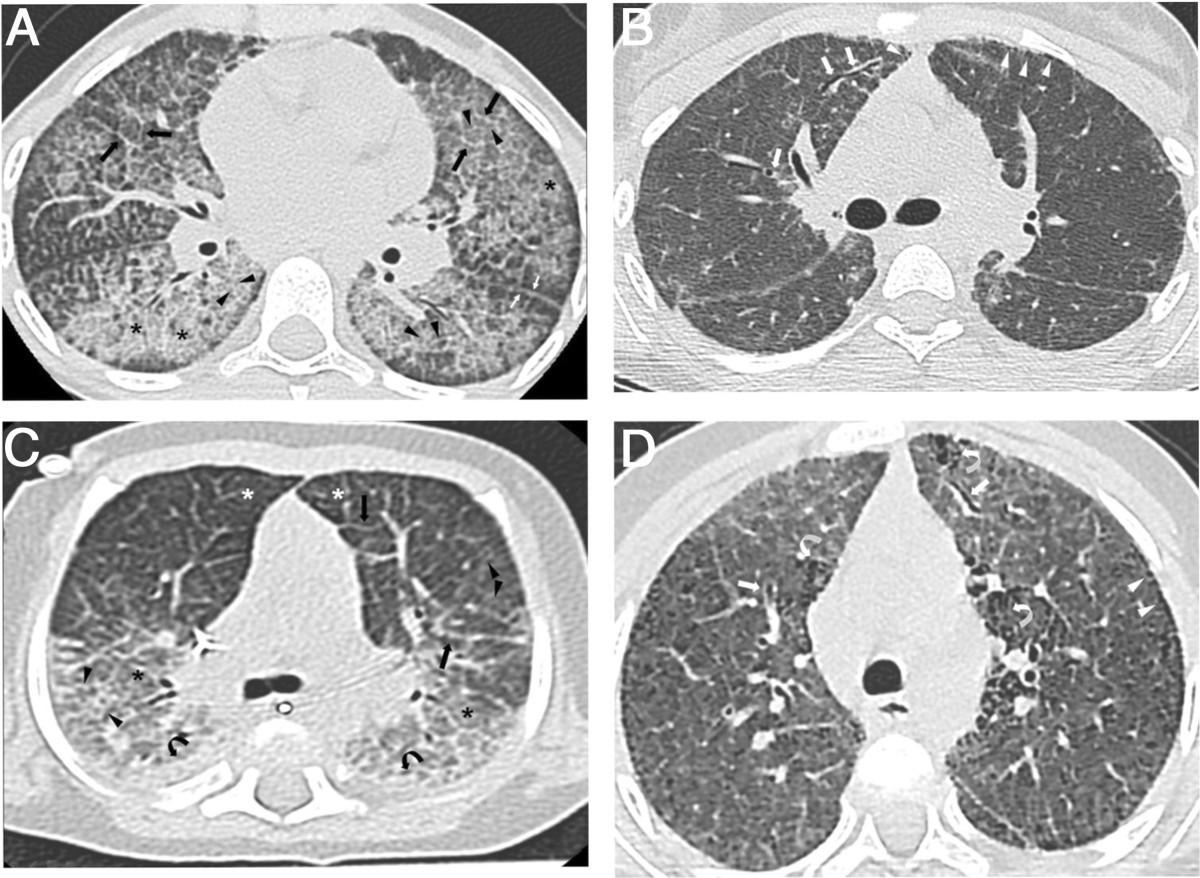 Pulmonary alveolar proteinosis in children on La Réunion Island: a new ...