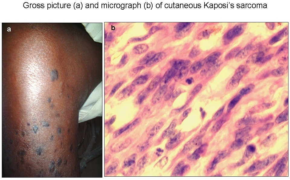 Human herpesvirus8 (HHV8) serodetection and HIV association in