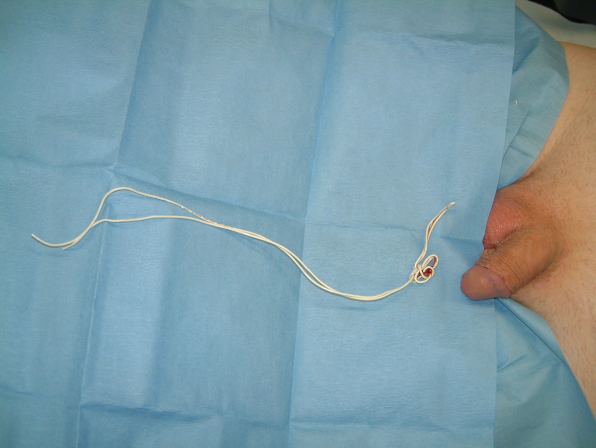 Successful Removal Of A Telephone Cable A Foreign Body Through The Urethra Into The Bladder A 2362