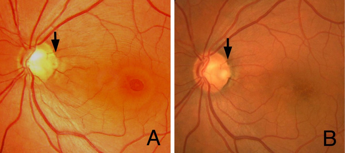 Vitrectomy combined with glial tissue removal at the optic pit in a patient with optic disc pit