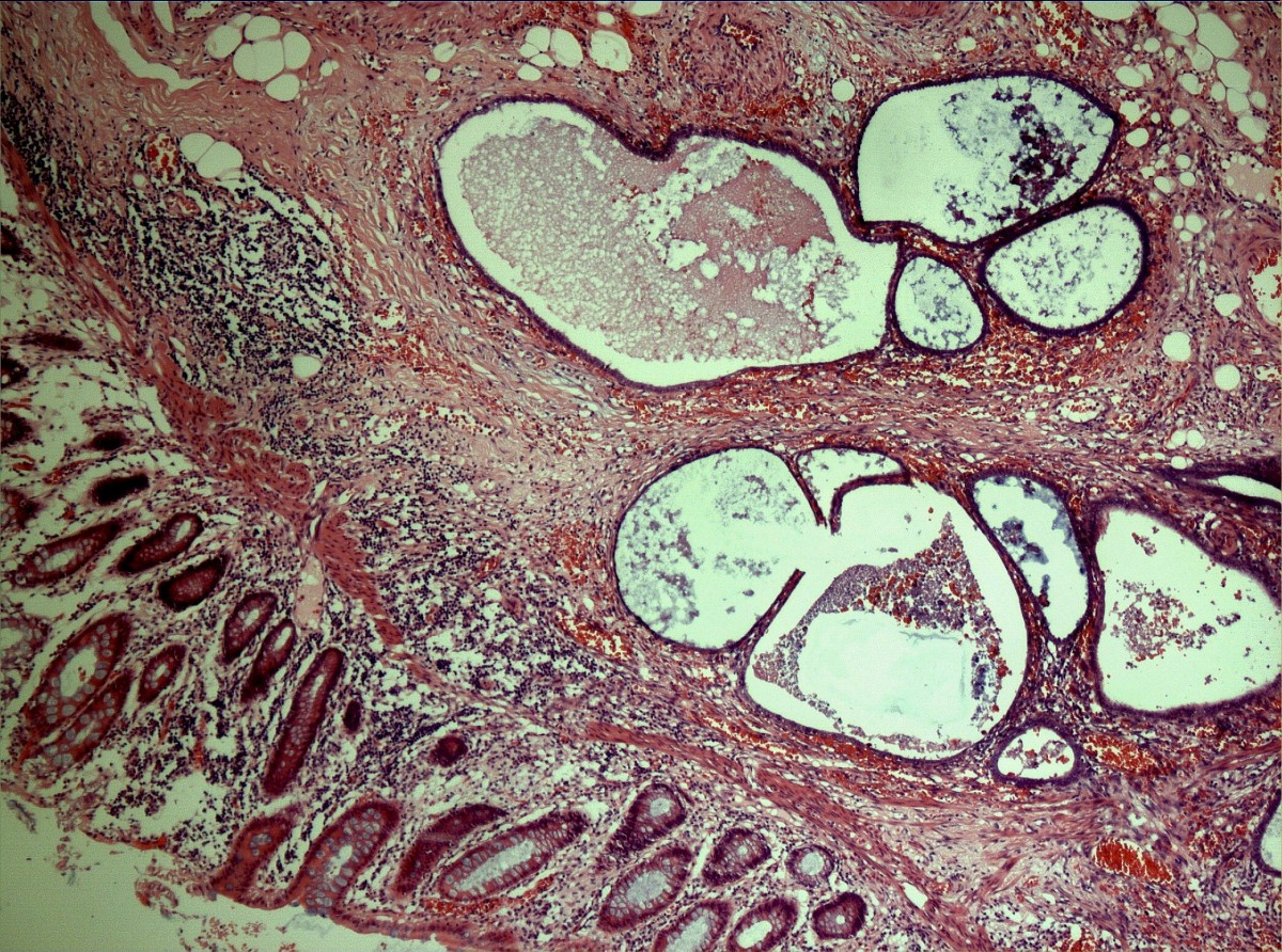 Intussusception of the appendix secondary to endometriosis a case