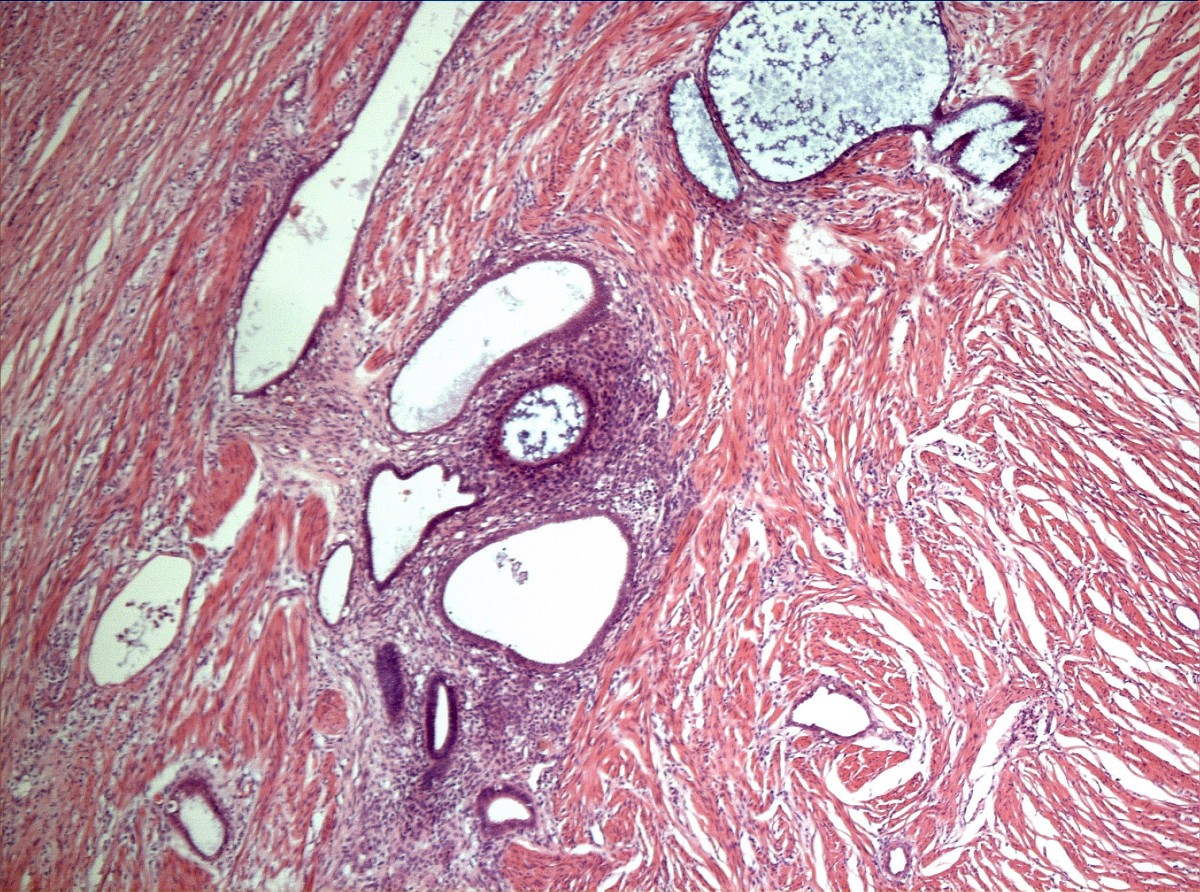 Intussusception of the appendix secondary to endometriosis a case