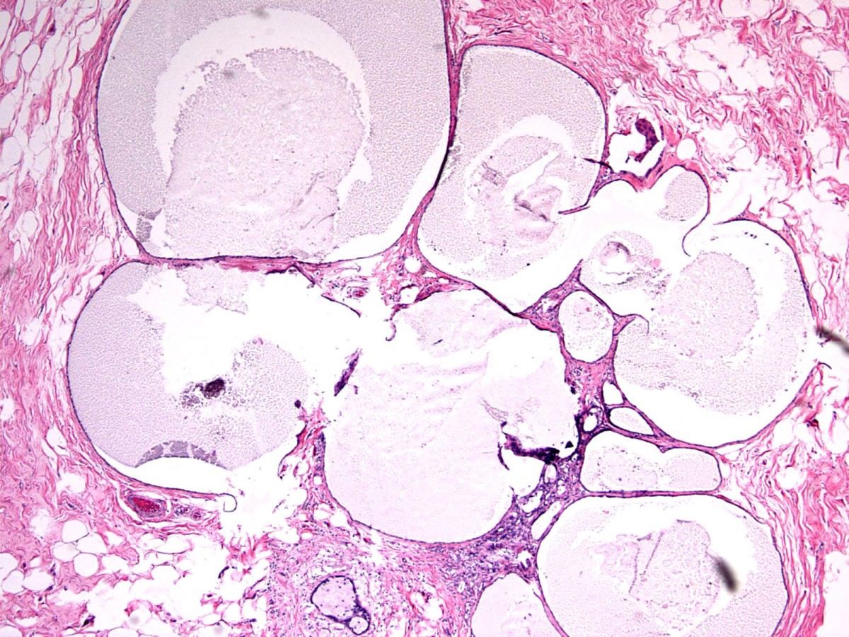 Mucocelelike tumor and columnar cell hyperplasia of the breast