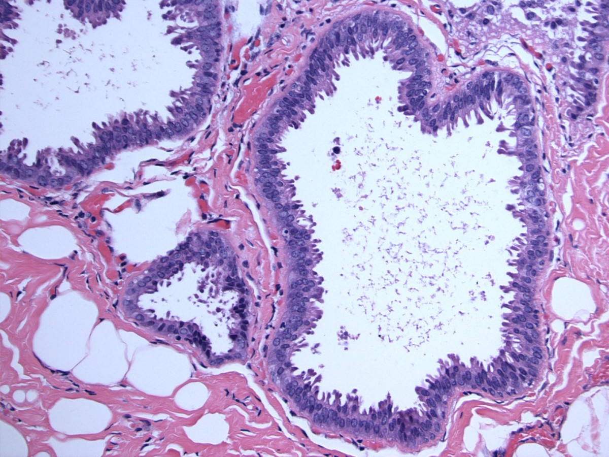 Mucocelelike tumor and columnar cell hyperplasia of the breast
