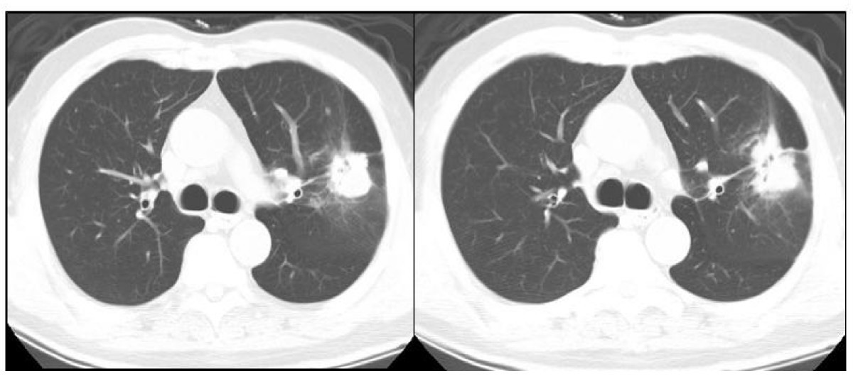 Coexistence of primary adenocarcinoma of the lung and ...