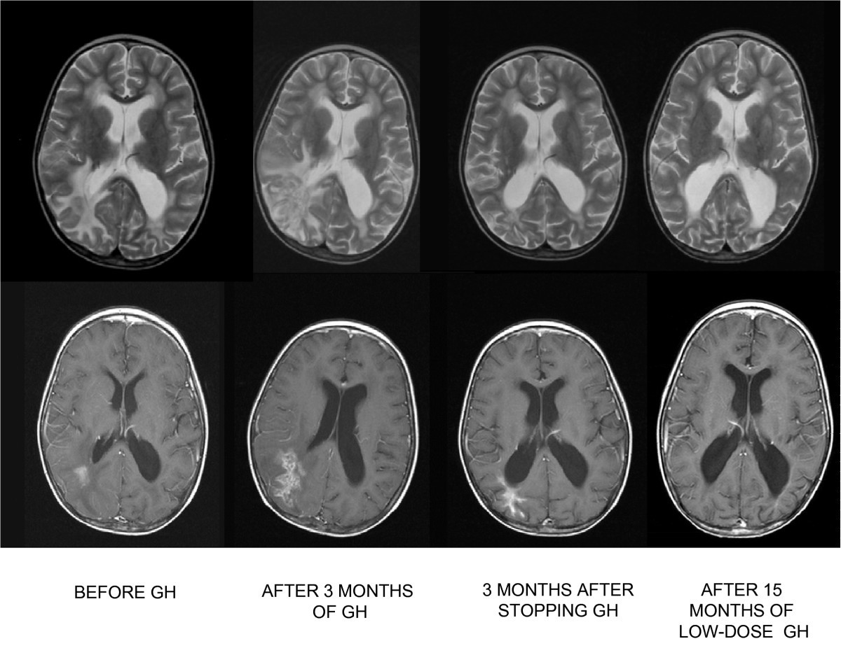 A female survivor of childhood medulloblastoma presenting with growth ...