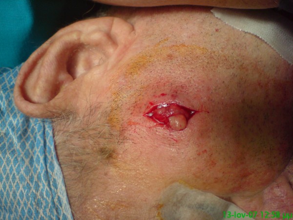 Facial skin metastasis due to small-cell lung cancer: a case report