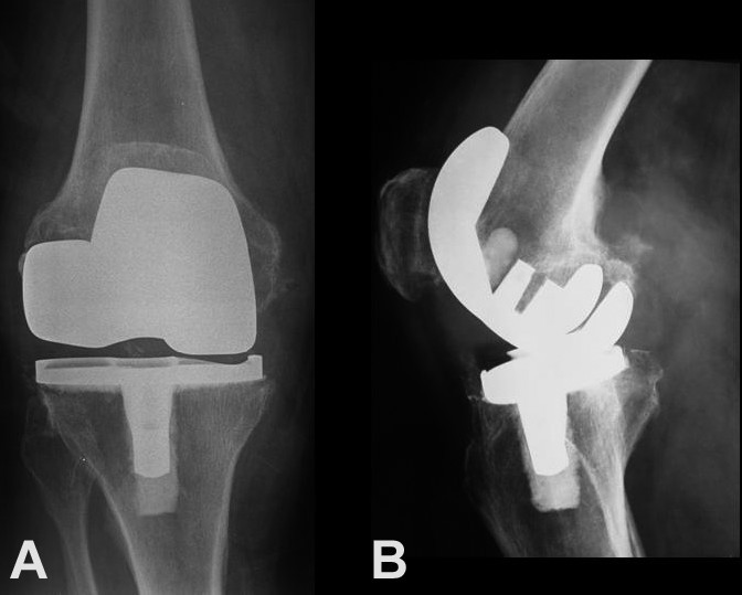 Wear debris pseudotumor following total knee arthroplasty: a case ...