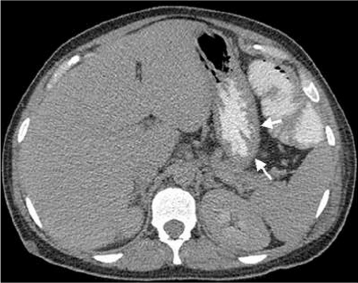 Successful medical management of emphysematous gastritis with