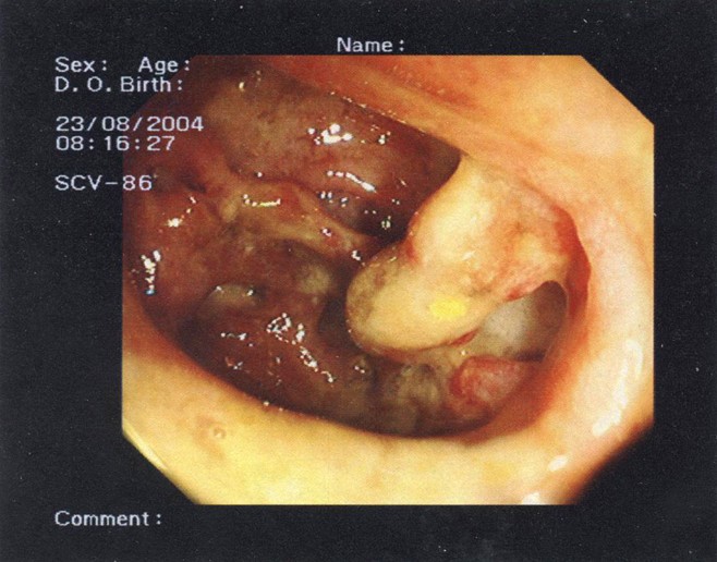 year old test blood 2 a sigmoid fistula in with Appendiceal presenting man