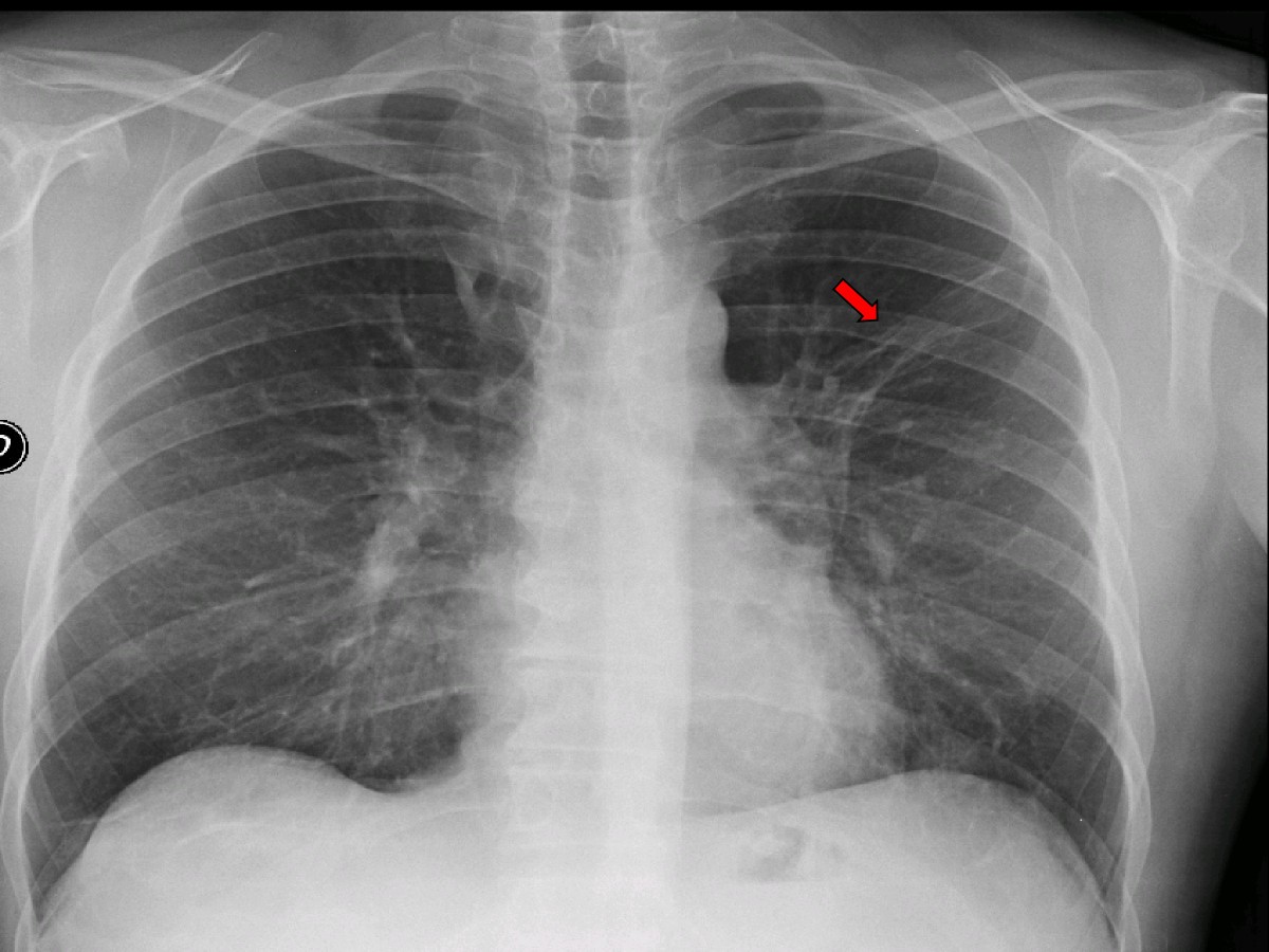 Eosinophilic Infiltrate In A Patient With Severe