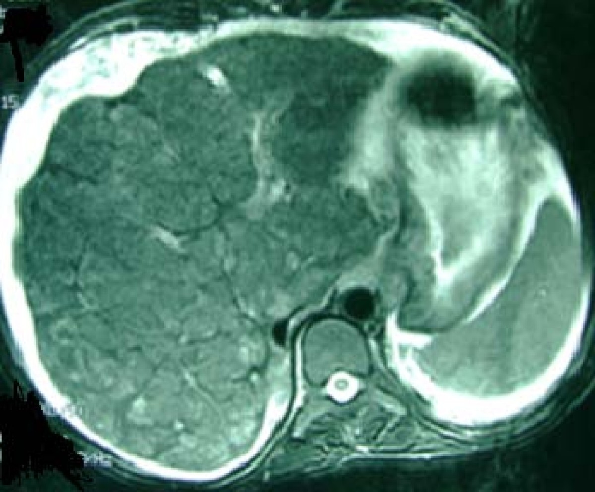Congenital hepatic fibrosis leading to cirrhosis and hepatocellular
