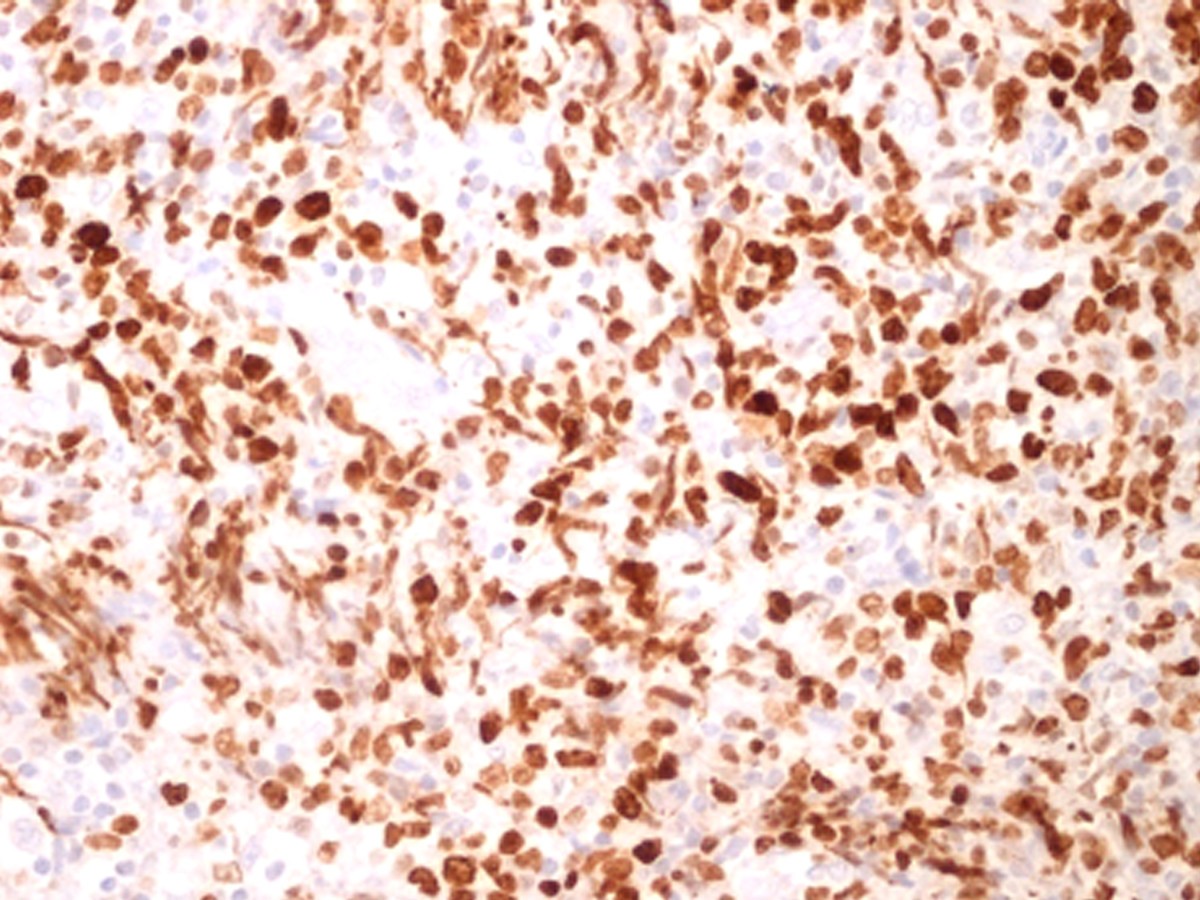 Clear cell variant of diffuse large Bcell lymphoma a case report