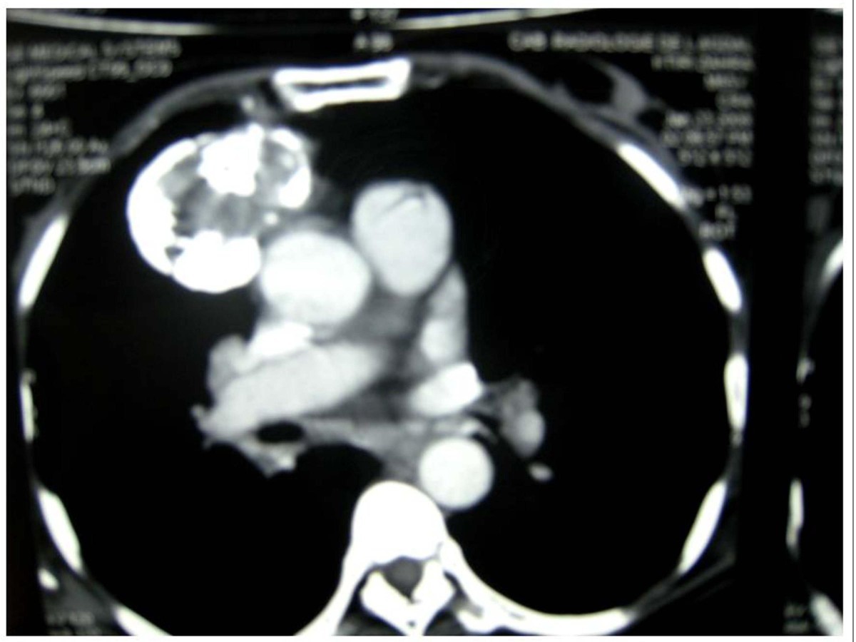 Calcified multilocular thymic cyst associated with thymoma a case