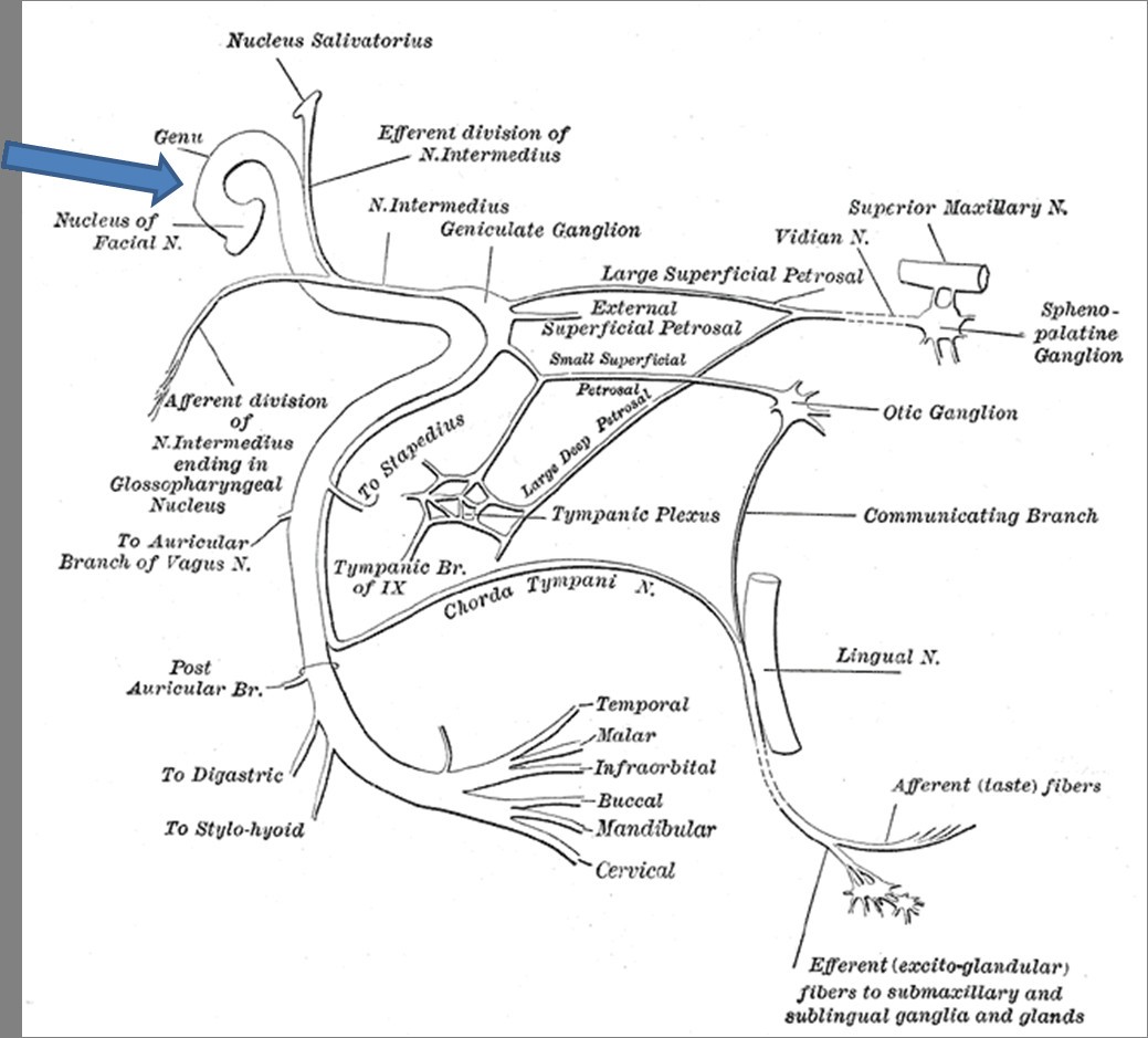 Pontine stroke presenting as isolated facial nerve palsy mimicking Bell ...