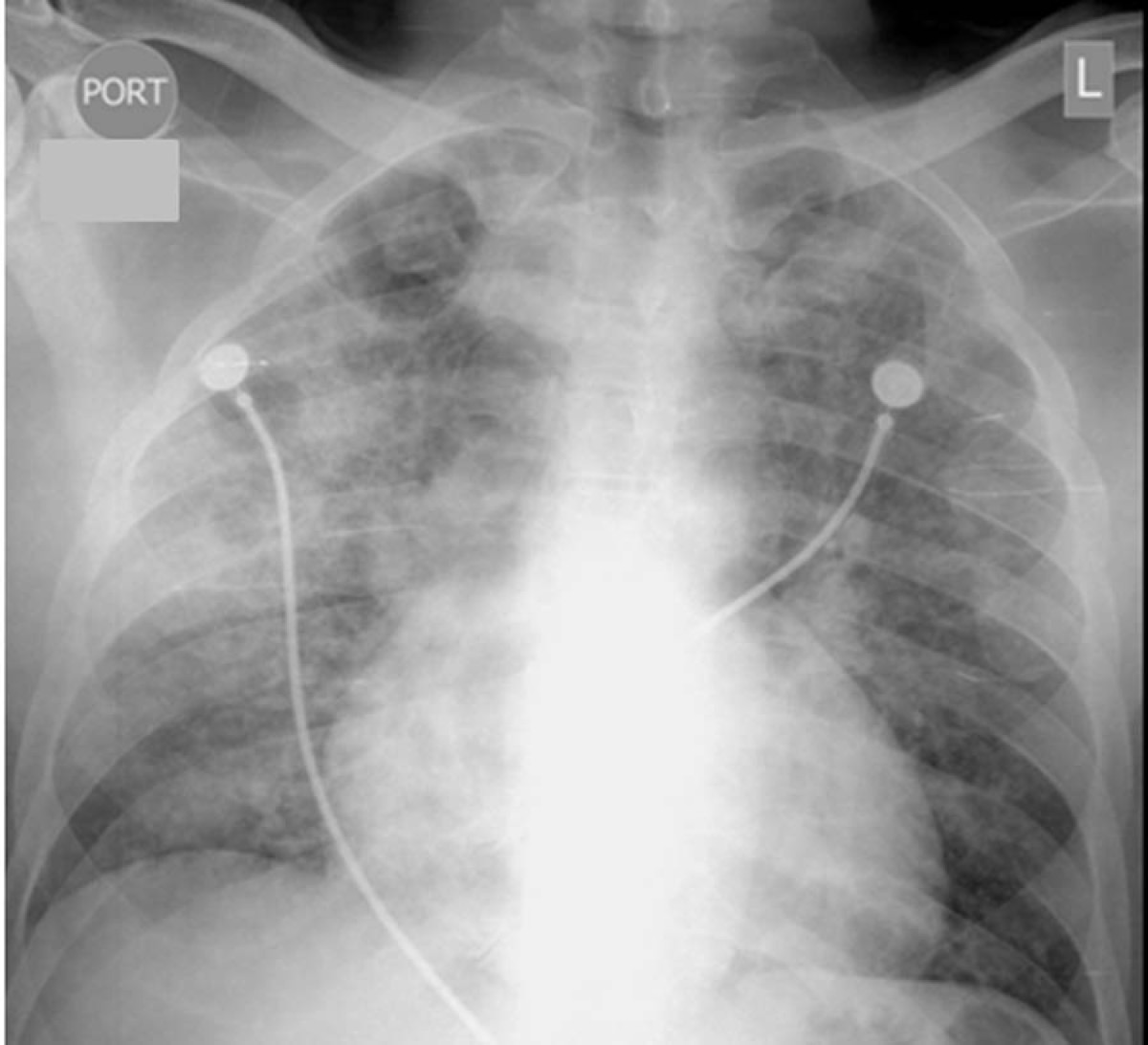 Unsuspected pulmonary alveolar proteinosis in a patient with acquired