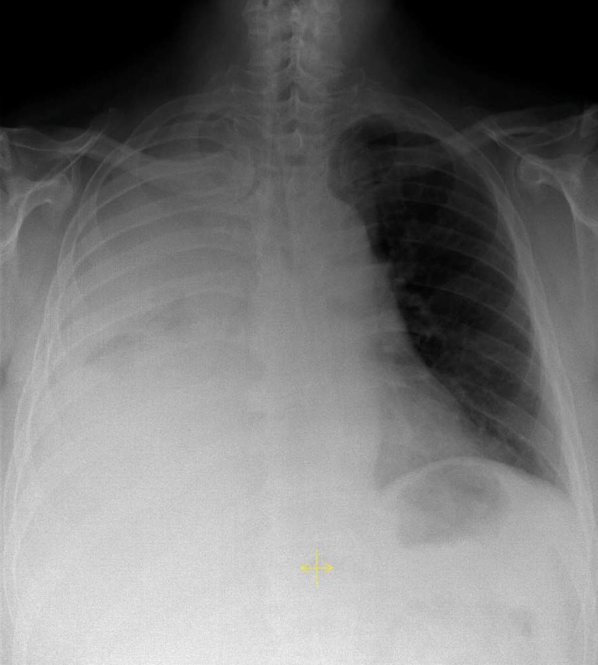 Persisting right-sided chylothorax in a patient with chronic 