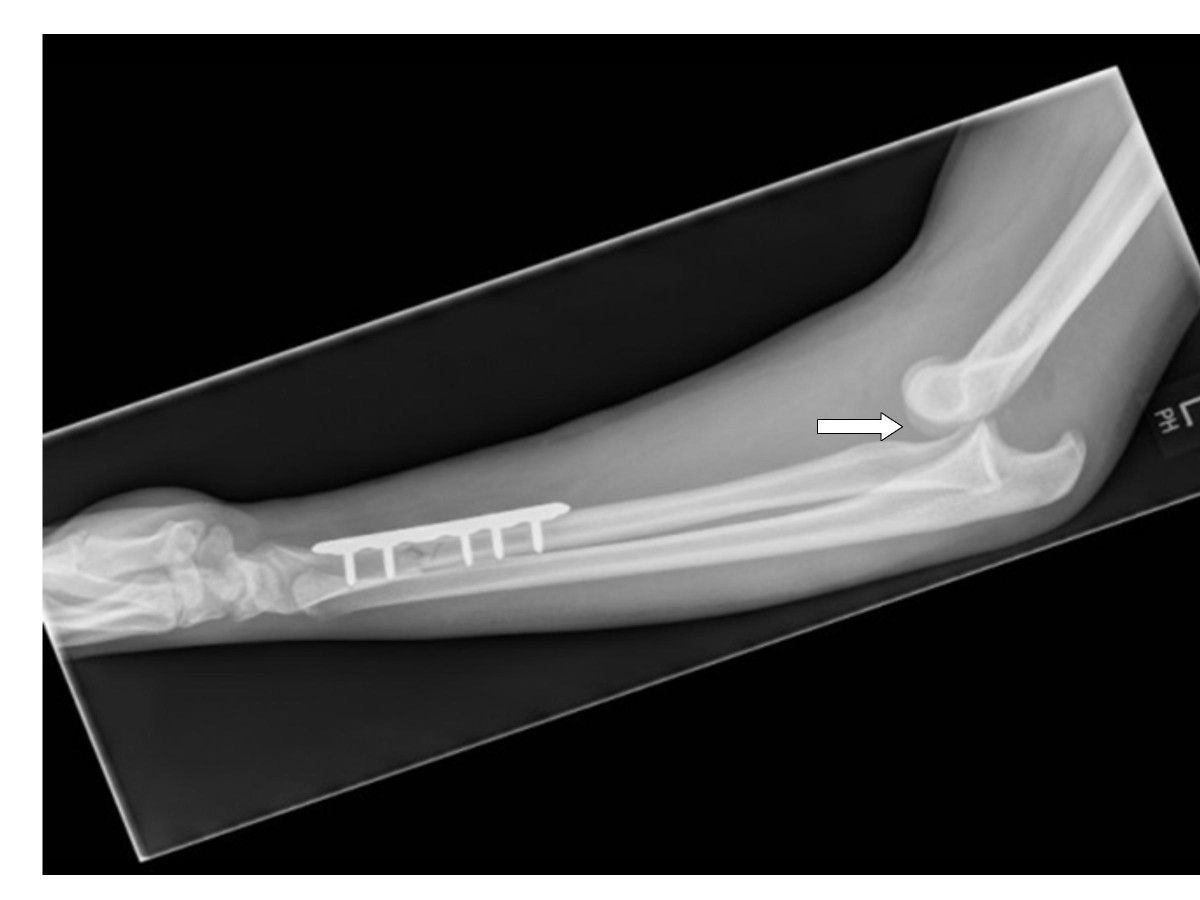 Subacute dislocation of the elbow following Galeazzi fracturedislocation of the radius A case